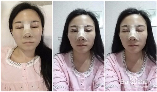 做了双眼皮，整个人美美哒