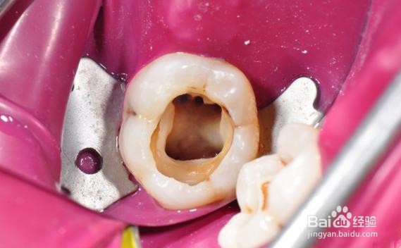 合肥补牙多少钱一颗