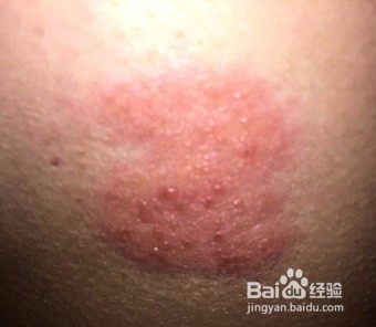 湿疹如何根治及禁忌