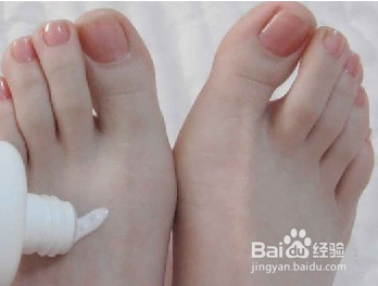 夏天得了脚气怎么办