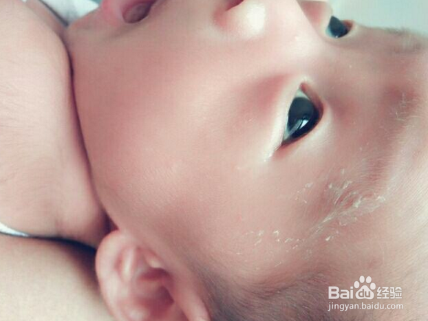 如何对新生宝宝的皮肤问题？