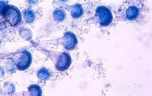 脂溢性脱发脂溢性皮炎防治要点