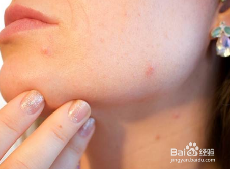 皮肤科医生揭示痤疮的主要原因