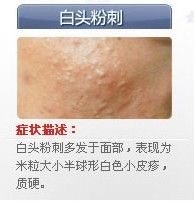 痘痘的种类有哪些