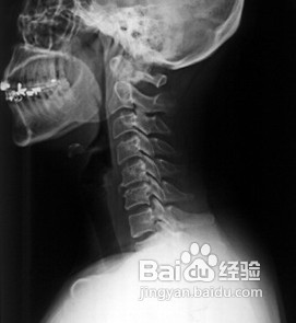 我们可以怎样预防颈椎病的发生