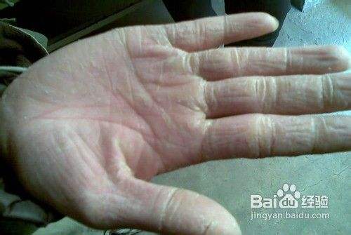 冬季手部异常干燥怎么办 百度经验