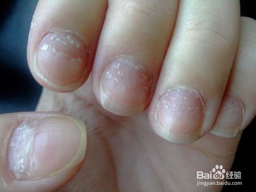 灰指甲图片初期症状，怎么确定是不是灰指甲
