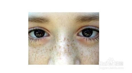 祛斑霜能去除黄褐斑吗