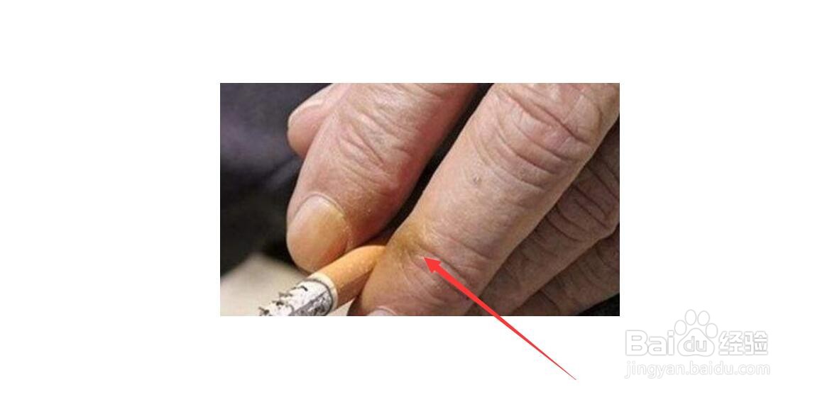 喜欢抽烟的朋友,手指受尼古丁的作用,就会发黄,怎么处理呢?