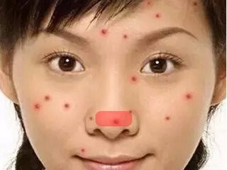 鼻子下面起泡速好方法