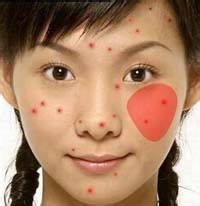 脸部痘痘辨别自己的身体信号！