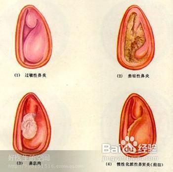 鼻腔异物该怎么办