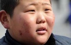 如何预防冻疮