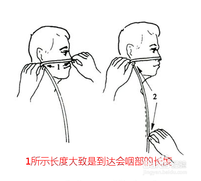 插胃管时测量长度的正确方法