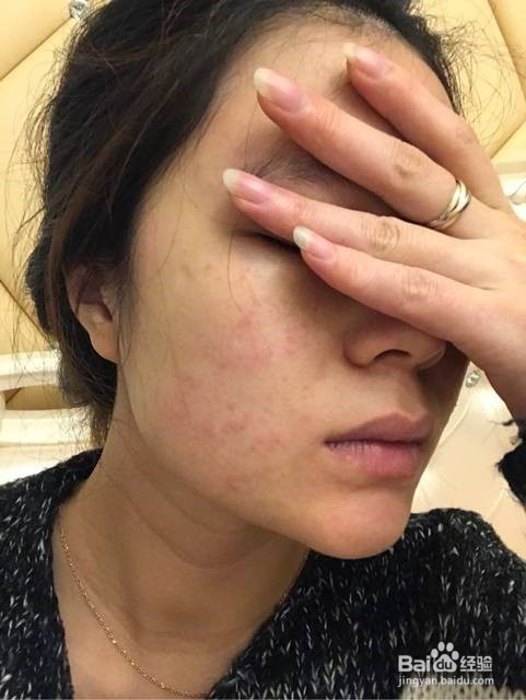 脸部过敏怎么办