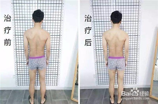 如何矫正高低肩呢