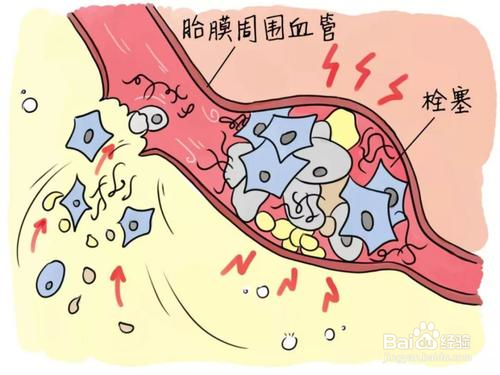 如何预防流产或分娩时羊水栓塞