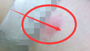 皮试青霉素过敏为什么,应该怎么办