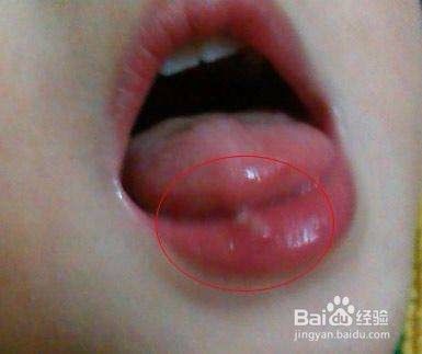 宝宝上火嘴唇起泡怎么办 百度经验