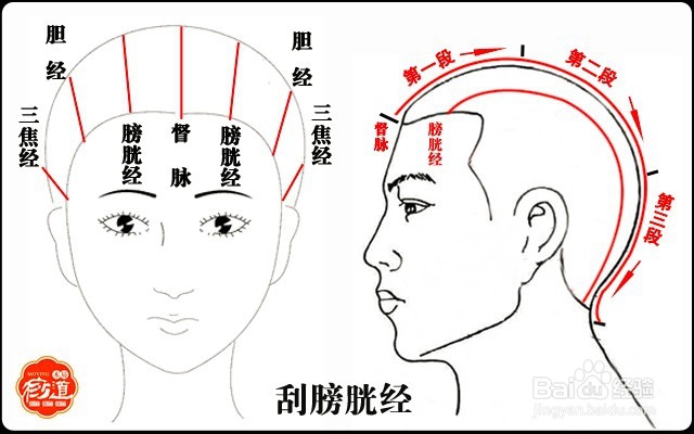 头部刮痧:头痛头晕、眼睛干涩、无精打采