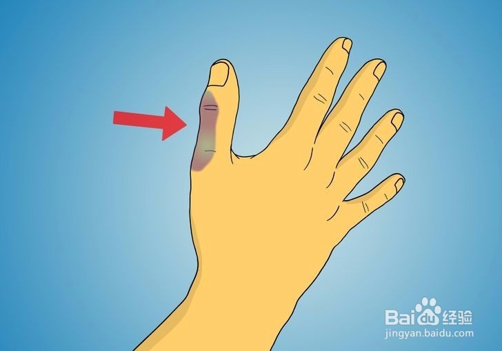 如何诊断拇指是否骨折?