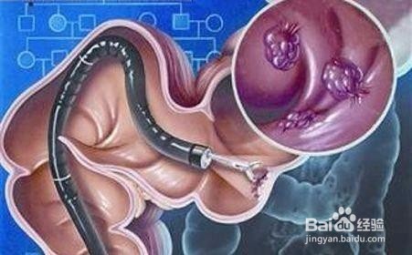如何发现和预防肠癌