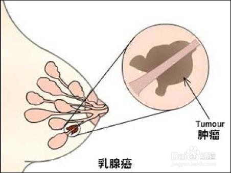 乳房肿块要做哪些检查