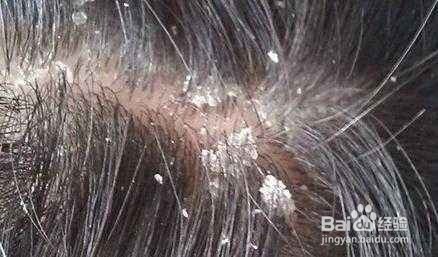 头皮屑多适合用什么洗发水呢?