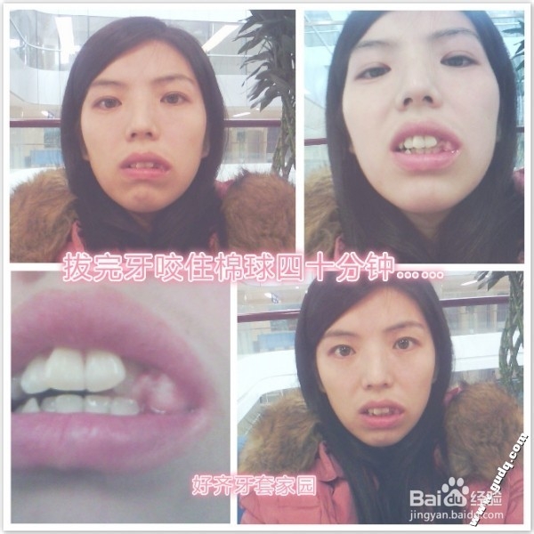 拔牙的过程和拔牙后的护理