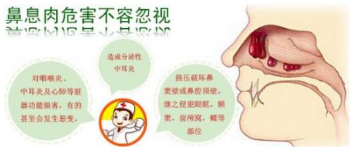 鼻息肉手术费用多少 百度经验