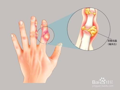 痛风适合喝哪些饮料?这六大饮品最适合