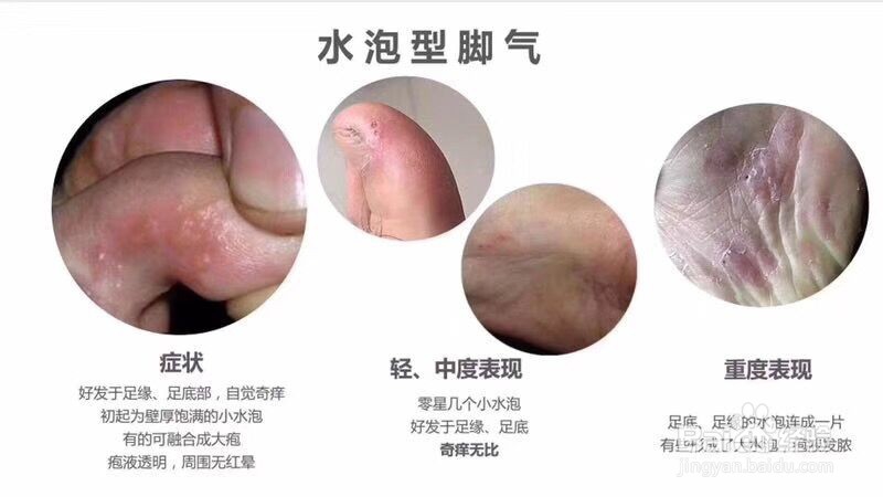 怎样识别不同类型的脚气