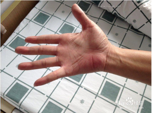 颈椎压迫神经的症状