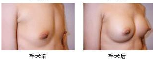 韩国假体隆胸效果怎么样 植入位置在哪里