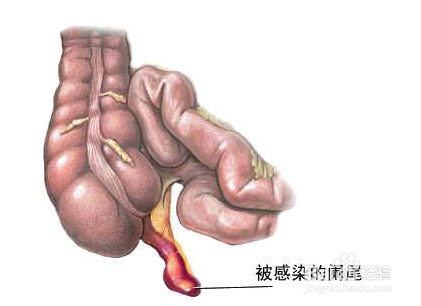 阑尾炎的人体位置图片图片