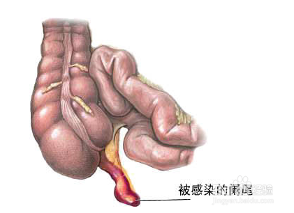 急性闌尾炎怎樣急救?