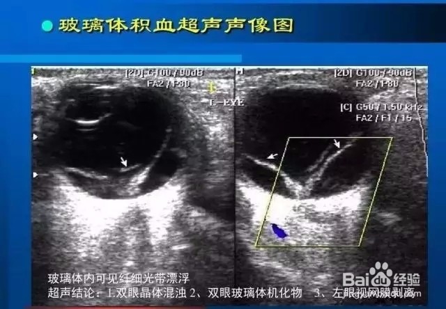 几种常见眼病B超图谱及诊断