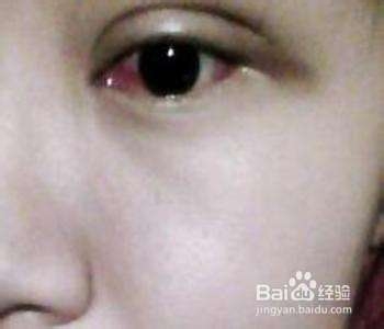 角膜炎有哪些症状？角膜炎怎么治？