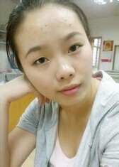 有了青春痘该怎么办？