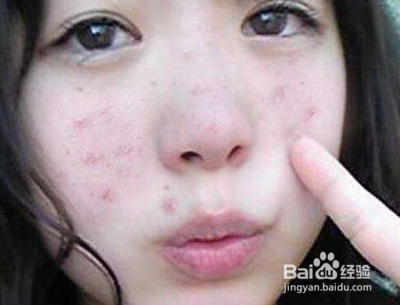 怎样判断脸上有角质