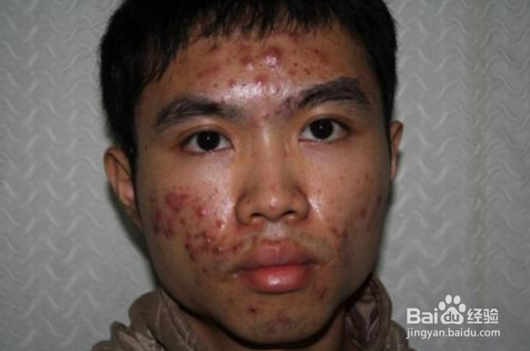 祛痘印最快的方法