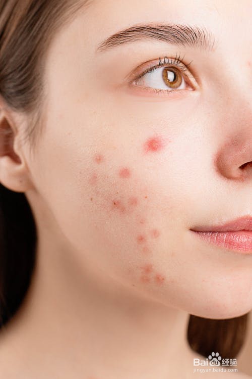 剖析长痘原因!分享痘痘去除小妙招