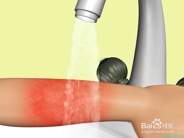 如何治疗烧伤？