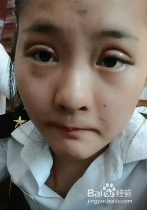 割完双眼皮怎样才能快速消肿，做双眼皮消肿快吗