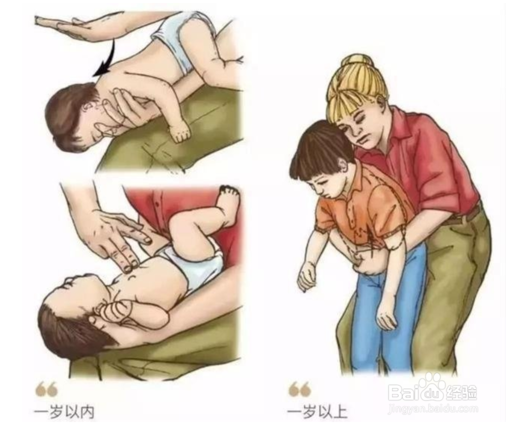 海姆立克急救法