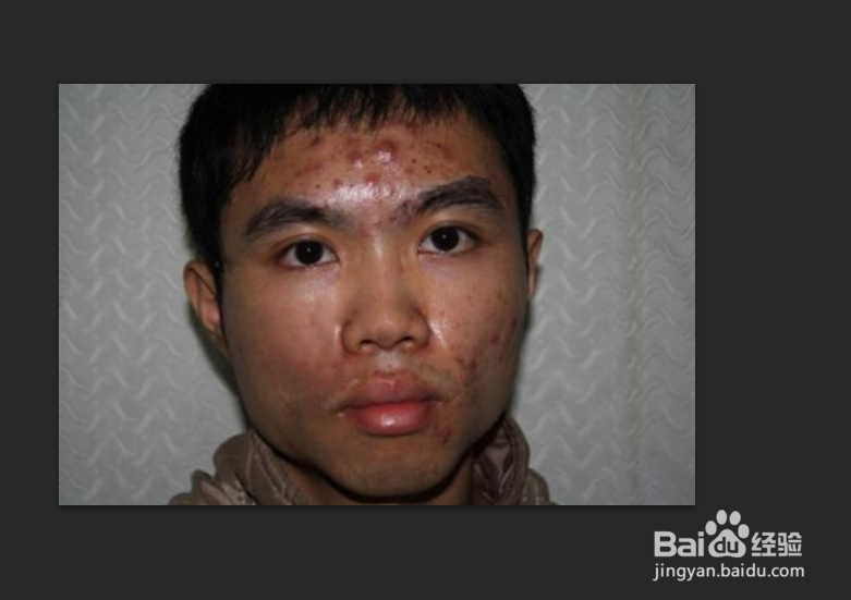 祛痘印最快的方法