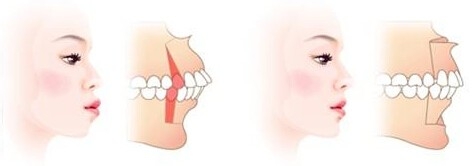 轻微龅牙怎么治疗