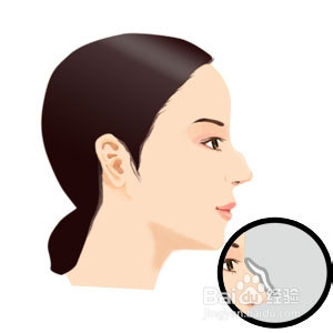 驼峰鼻矫正解决方案