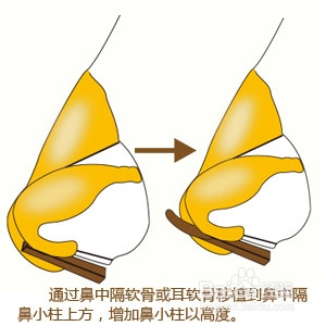 鼻小柱整形解决方案