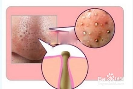 教你自己在家用普通的的东西去黑头